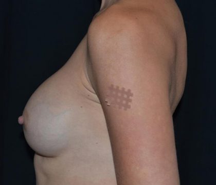 Breast Augmentation - Round Silicone Implants Before & After Patient #20366