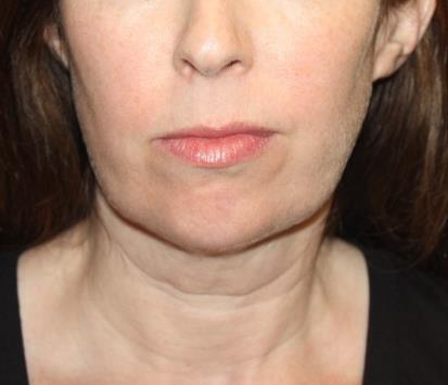 Kybella Before & After Patient #19825