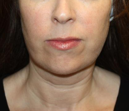 Kybella Before & After Patient #19825