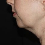 Kybella Before & After Patient #19825