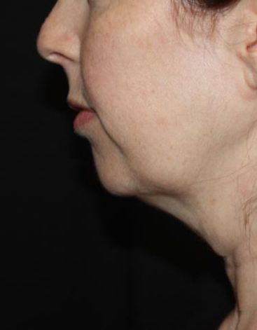 Kybella Before & After Patient #19825