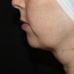 Kybella Before & After Patient #19825