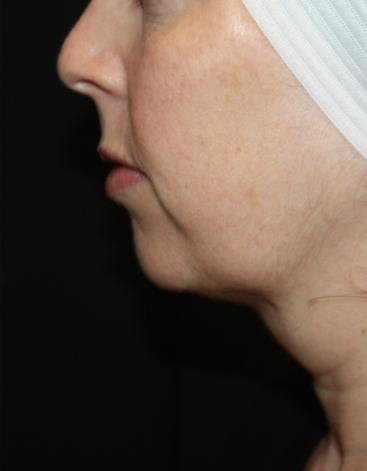 Kybella Before & After Patient #19825