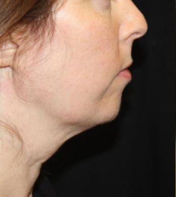 Kybella Before & After Patient #19825