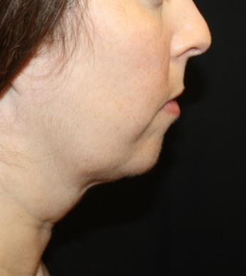 Kybella Before & After Patient #19825