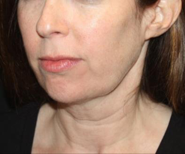 Kybella Before & After Patient #19825