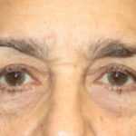 Blepharoplasty Before & After Patient #25224