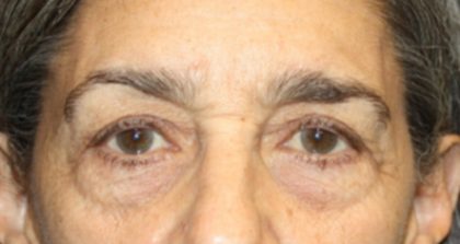 Blepharoplasty Before & After Patient #25224