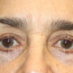 Blepharoplasty Before & After Patient #25224