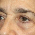 Blepharoplasty Before & After Patient #25224