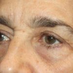 Blepharoplasty Before & After Patient #25224