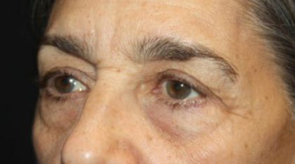 Blepharoplasty Before & After Patient #25224