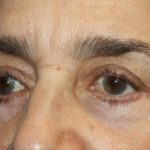 Blepharoplasty Before & After Patient #25224