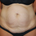 Tummy Tuck Before & After Patient #19930