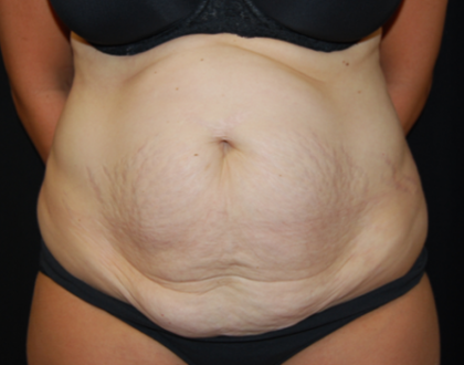 Tummy Tuck Before & After Patient #19930