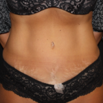 Tummy Tuck Before & After Patient #19930