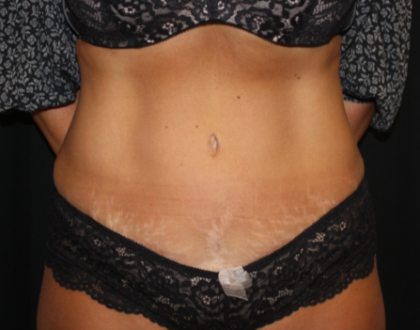 Tummy Tuck Before & After Patient #19930