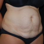 Tummy Tuck Before & After Patient #19930
