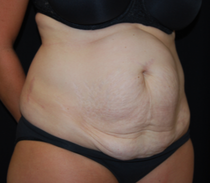 Tummy Tuck Before & After Patient #19930