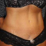 Tummy Tuck Before & After Patient #19930