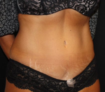 Tummy Tuck Before & After Patient #19930