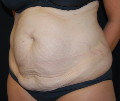 Tummy Tuck Before & After Patient #19930