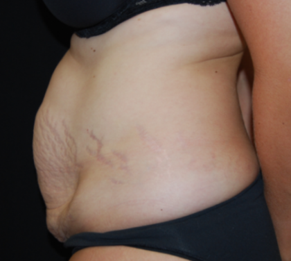 Tummy Tuck Before & After Patient #19930