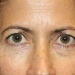 Blepharoplasty and Brow Lift Before & After Patient #20287