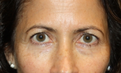 Blepharoplasty and Brow Lift Before & After Patient #20287