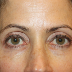 Blepharoplasty and Brow Lift Before & After Patient #20287