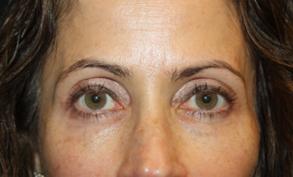 Blepharoplasty and Brow Lift Before & After Patient #20287