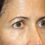 Blepharoplasty and Brow Lift Before & After Patient #20287