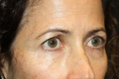 Blepharoplasty and Brow Lift Before & After Patient #20287