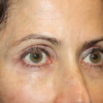 Blepharoplasty and Brow Lift Before & After Patient #20287