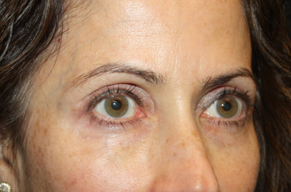 Blepharoplasty and Brow Lift Before & After Patient #20287