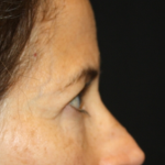 Blepharoplasty and Brow Lift Before & After Patient #20287