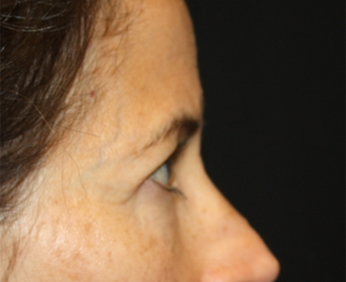 Blepharoplasty and Brow Lift Before & After Patient #20287