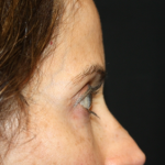 Blepharoplasty and Brow Lift Before & After Patient #20287