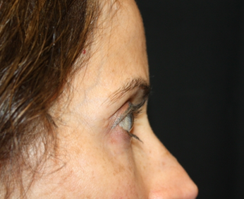 Blepharoplasty and Brow Lift Before & After Patient #20287