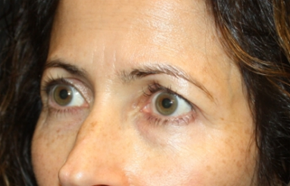 Blepharoplasty and Brow Lift Before & After Patient #20287