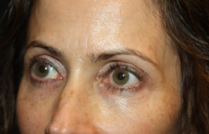 Blepharoplasty and Brow Lift Before & After Patient #20287