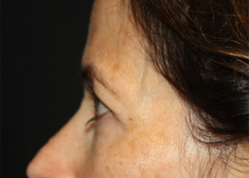 Blepharoplasty and Brow Lift Before & After Patient #20287