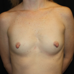 Nipple Revision Before & After Patient #20877