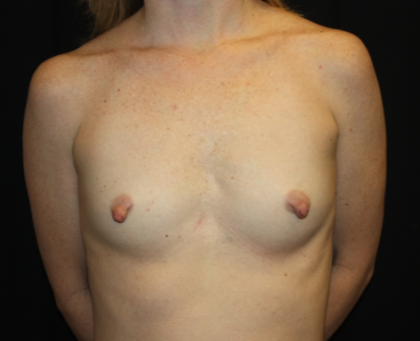 Nipple Revision Before & After Patient #20877