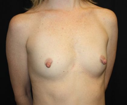 Nipple Revision Before & After Patient #20877