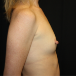 Nipple Revision Before & After Patient #20877