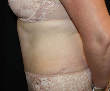 Tummy Tuck Before & After Patient #22791