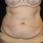 Tummy Tuck Before & After Patient #22791