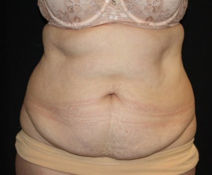 Tummy Tuck Before & After Patient #22791