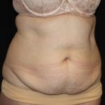 Tummy Tuck Before & After Patient #22791